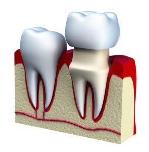 Santa Fe dental implant