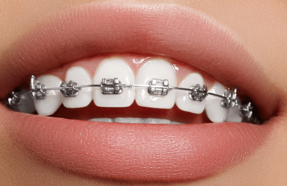 beacon braces beacon braces