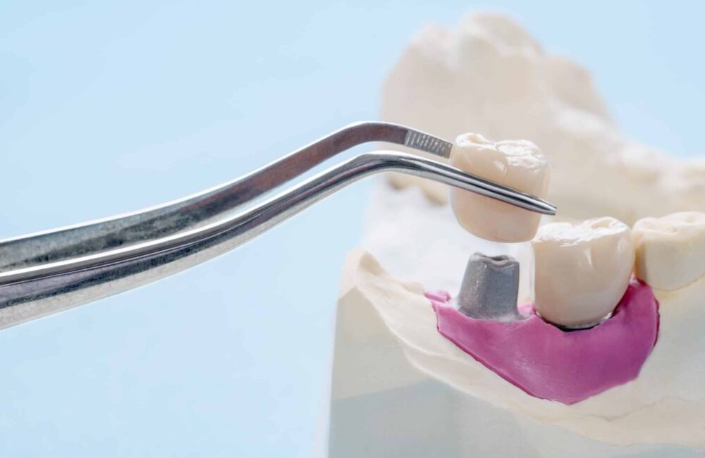 Implant restorations edmond