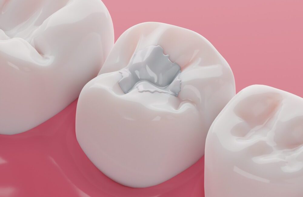 dental fillings edmond