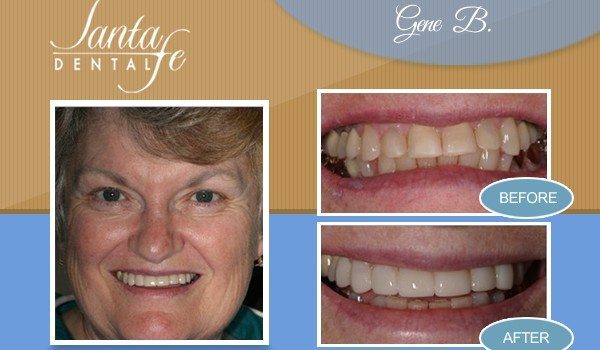 Edmond Veneer Dentist