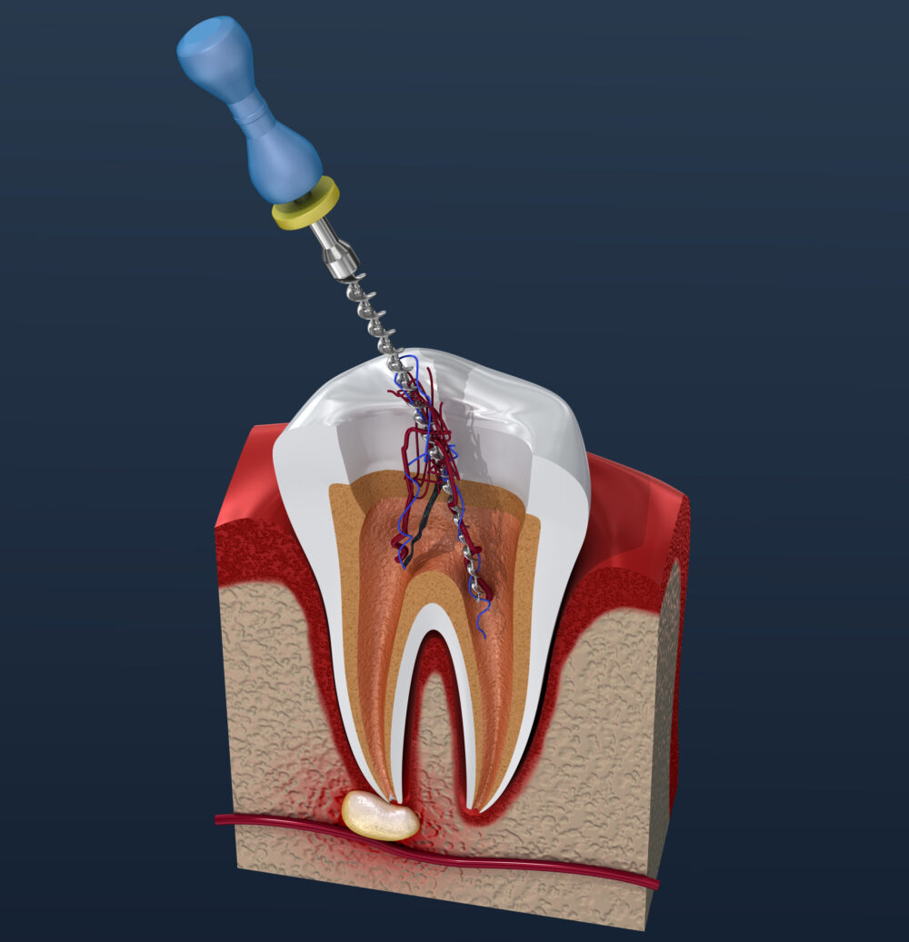 how long does a root canal take